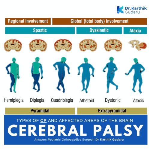 Different Types of Cerebral Palsy Dr Karthik Gudaru