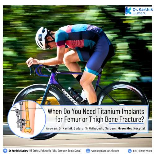 Dr Karthik Gudaru Titanium Implants for Thigh Bone Fracture in Hyderabad