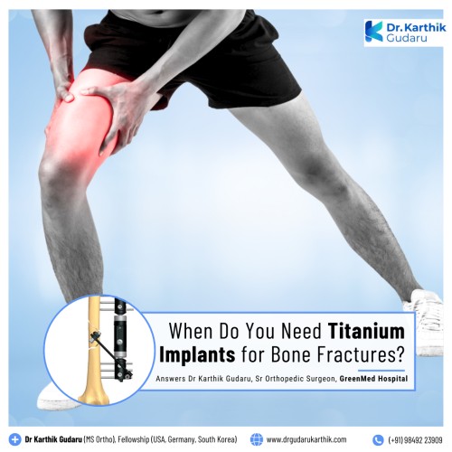 Dr Karthik Gudaru orthopedic surgeon for Titanium Implants for Thigh Bone Fracture