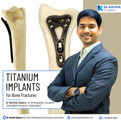 Dr Karthik Gudaru orthopedic surgeon for Titanium Implants for Thigh Bone Fracture
