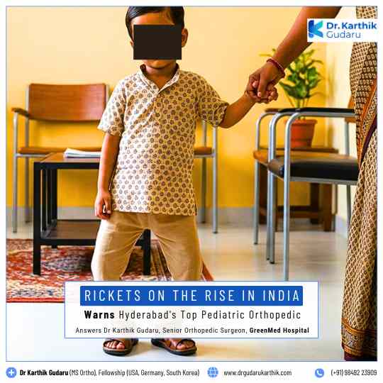 Rickets treatment in Hyderabad by Pediatric Orthopedic Dr Karthik Gudaru