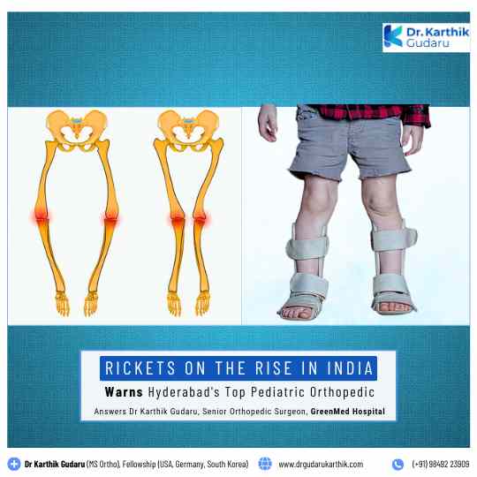 Rickets treatment in Hyderabad by Pediatric Orthopedic Dr Karthik Gudaru
