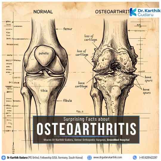 Surprising Facts About Osteoarthritis by Dr Karthik Gudaru Hyderabad