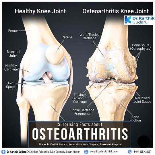 Surprising Facts About Osteoarthritis by Dr Karthik Gudaru Hyderabad